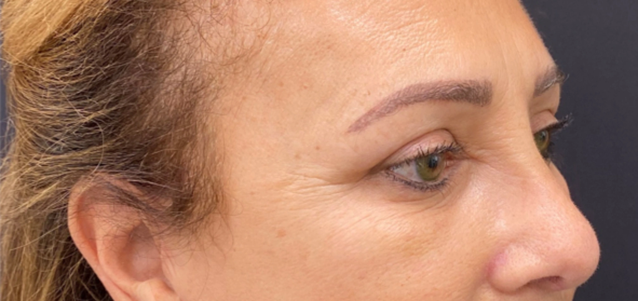 Quad-Blepharoplasty-Case--2302 | After Dr. Arjun Kanuri 2