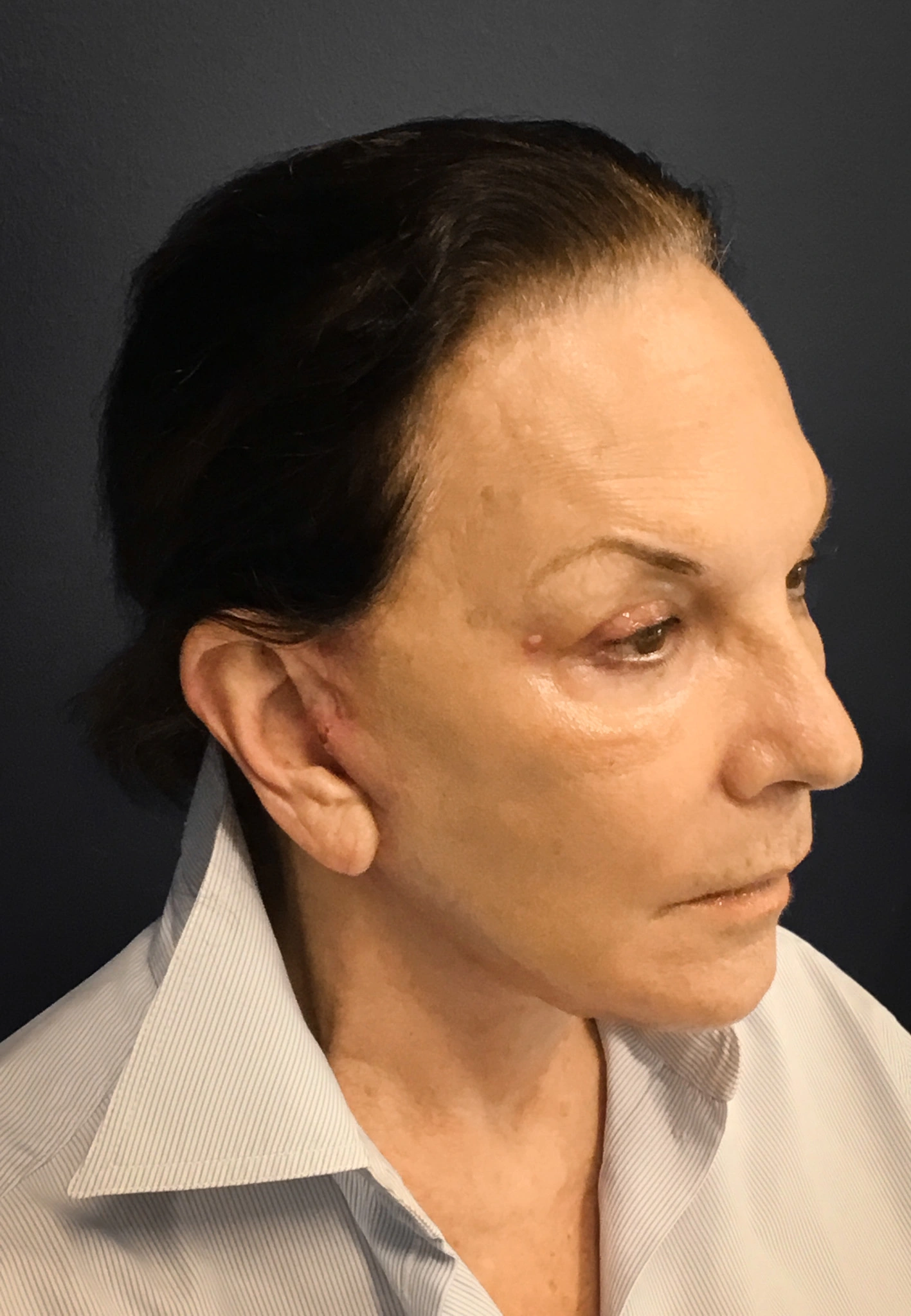 Revision-Facelift-Case--3082 | After Facelift 3
