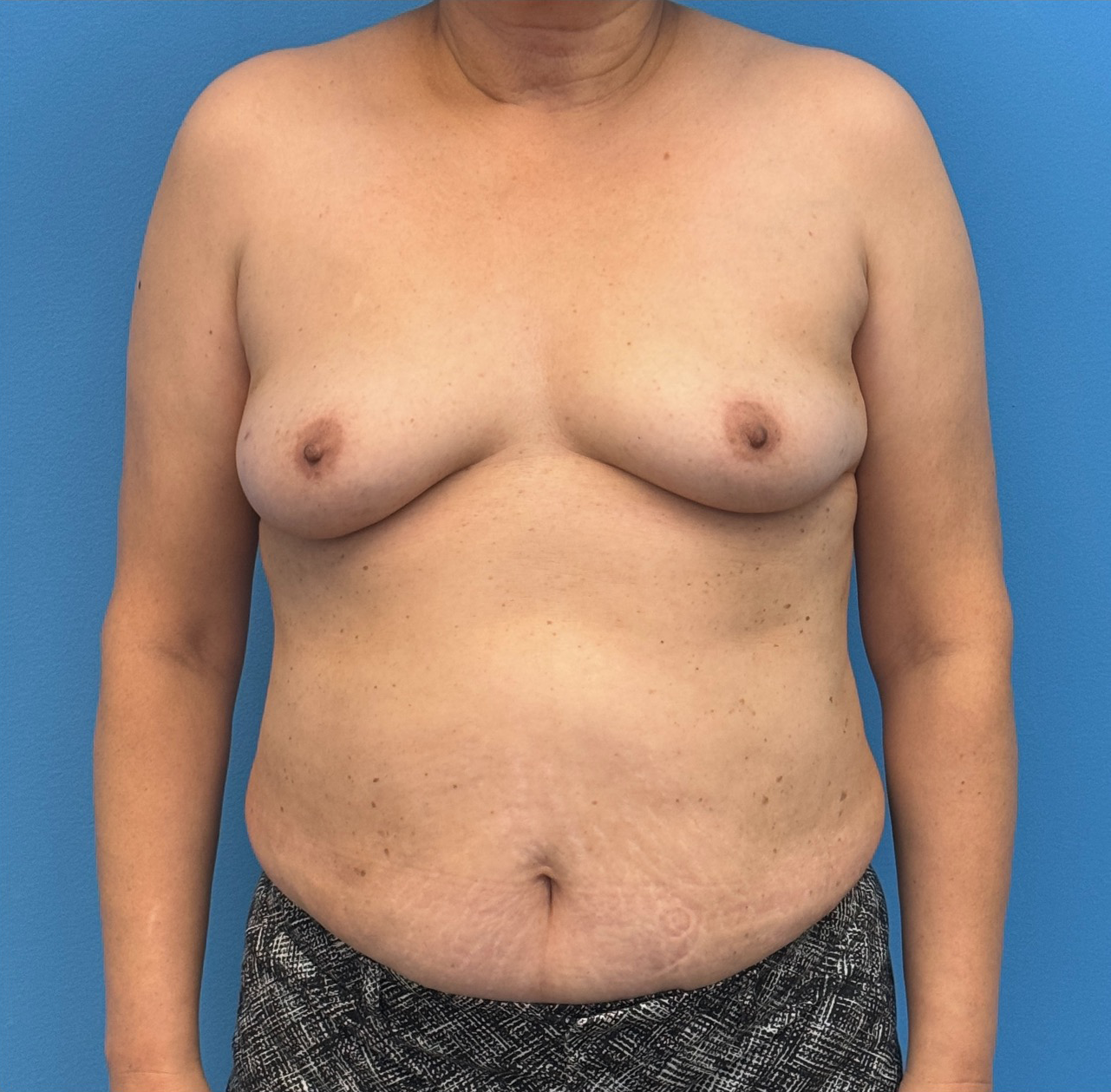 Breast-Reconstruction-Case--28751 | Before Breast 1