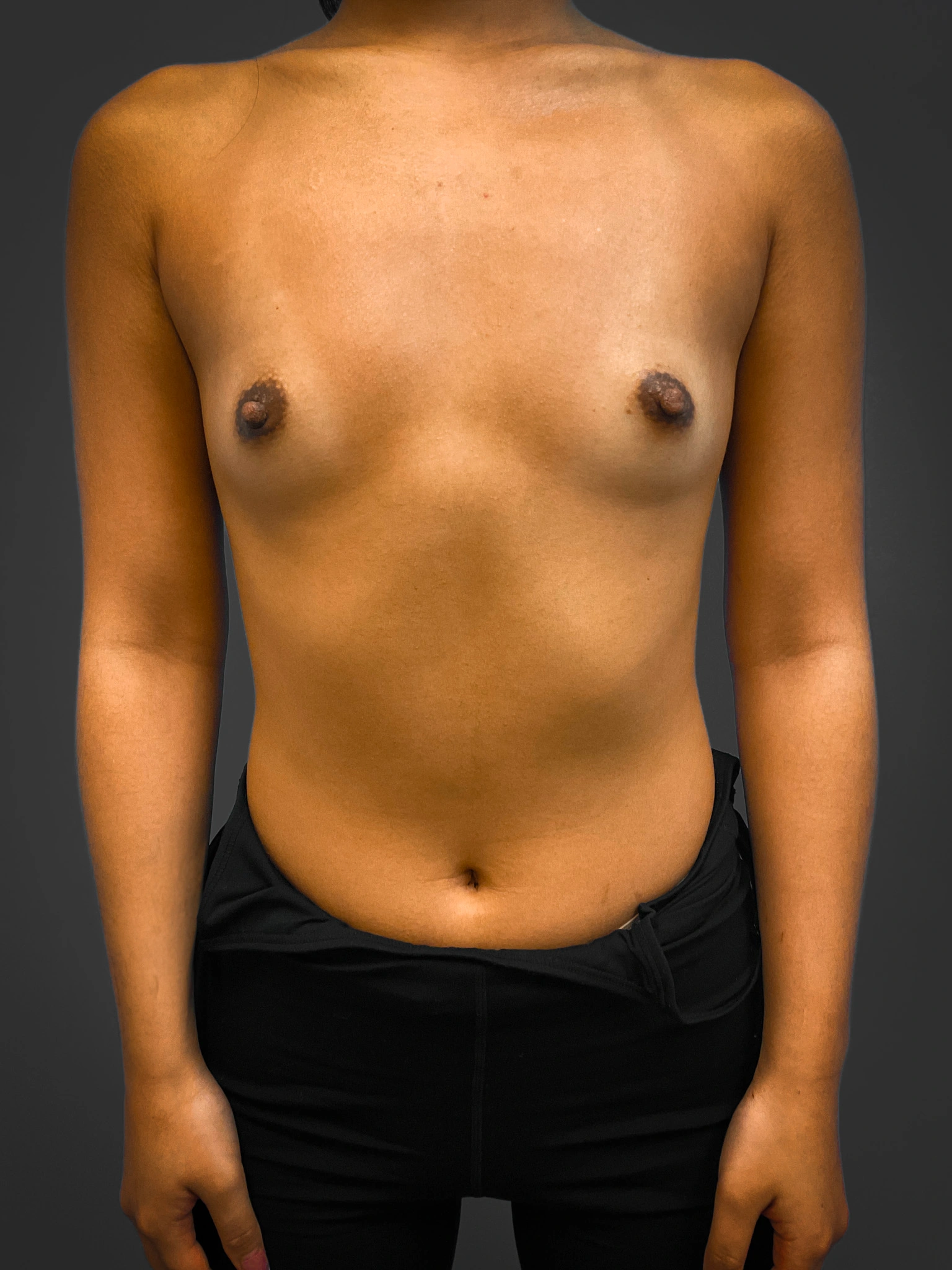 Breast-Augmentation-Case--4631 | Before Breast 1