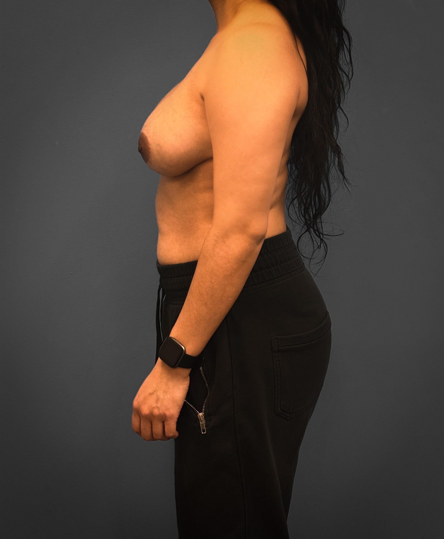 Breast-Reconstruction-Case--7171 | Before Breast 2