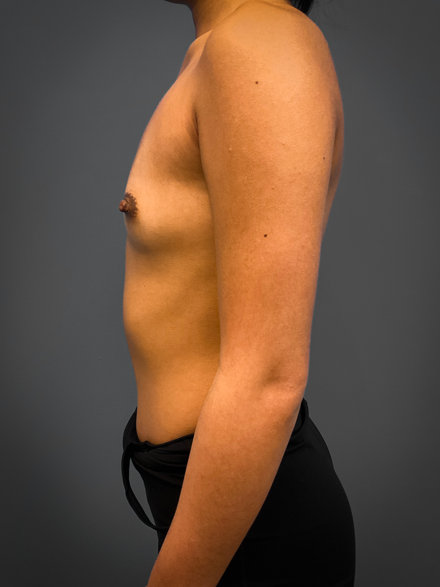 Breast-Augmentation-Case--4631 | Before Breast 2