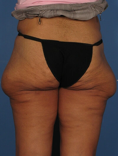 Thigh-lift-Case--75 | Before CPS Plastic Surgeons 2