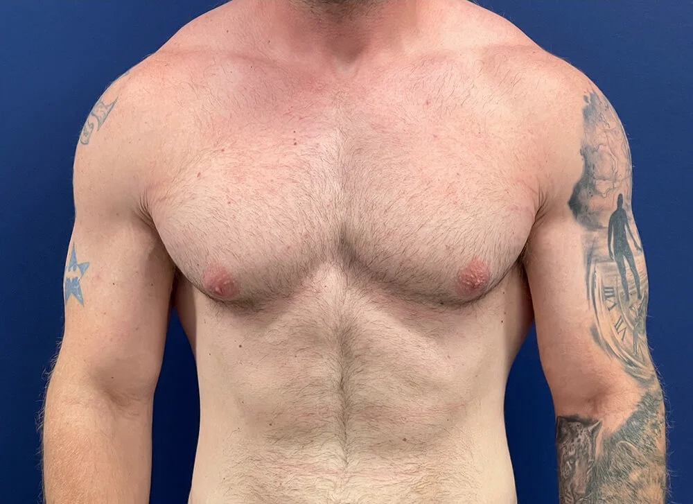 Gynecomastia-Case--28230 | Before Breast 1