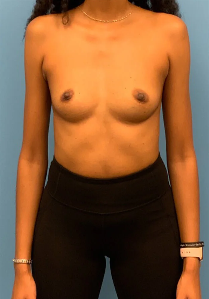 Breast-Augmentation-Case--26022 | Before Breast 1