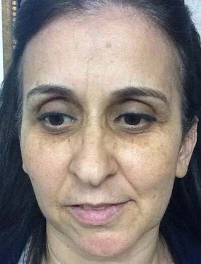 Chemical-Peel-Case--36 | Before Non-Surgical 1