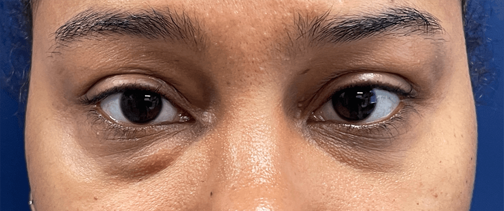 Lower-Blepharoplasty-Case--28049 | Before Eyelid Surgery 1