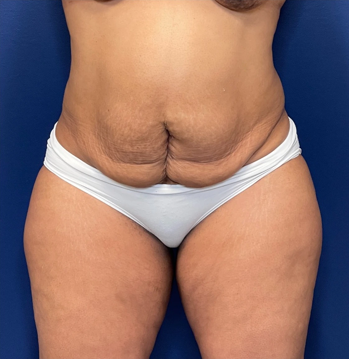 Liposuction-Case--254 | Before Liposuction 1