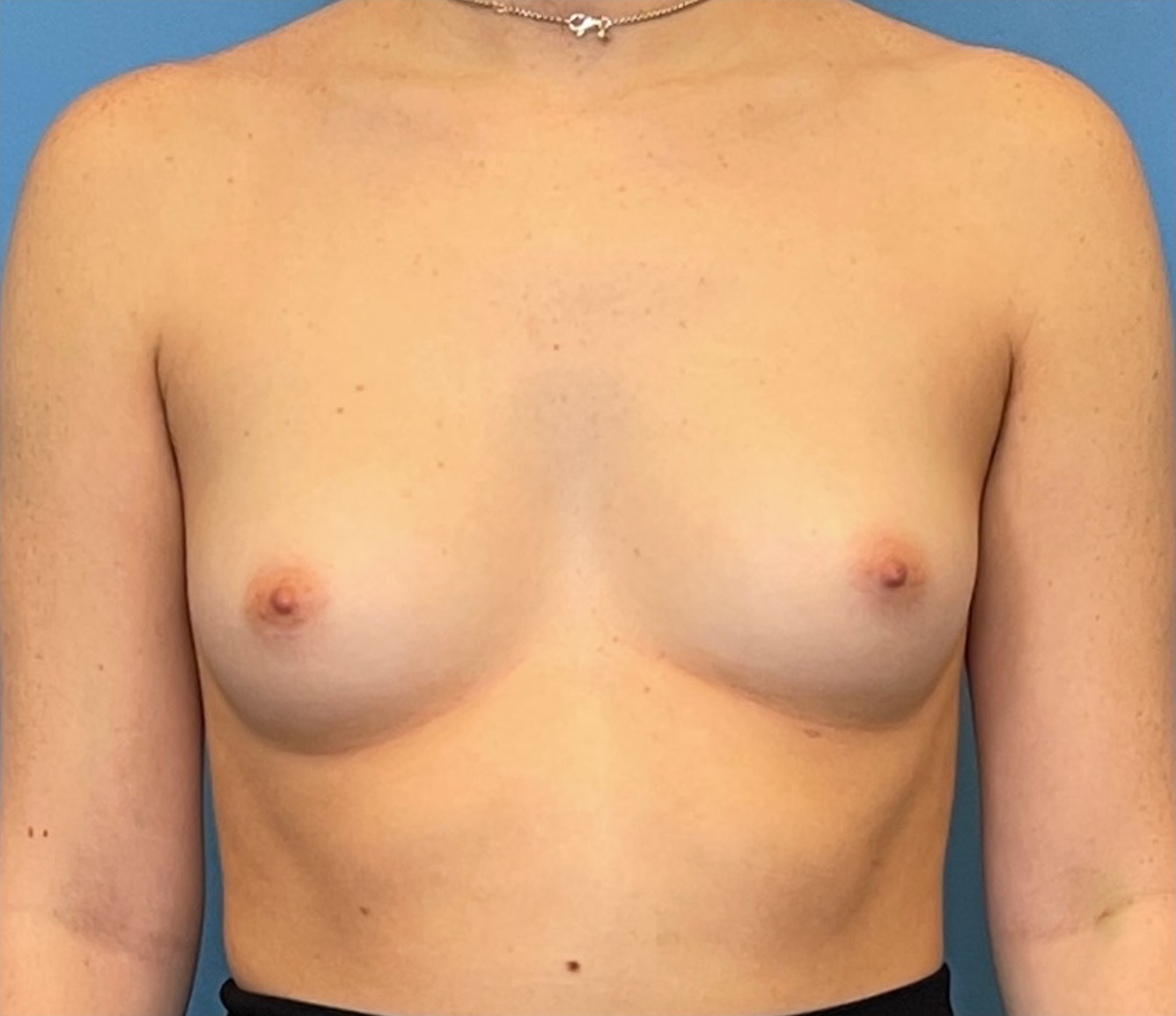 Breast-Augmentation-Case--224 | Before Breast 1