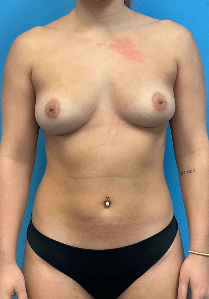 Breast-Augmentation-Case--23895 | Before Breast 1