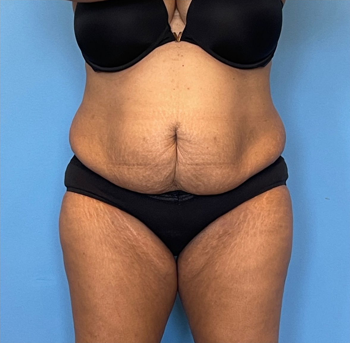 Lipoabdominoplasty-Case--255 | Before Liposuction 1
