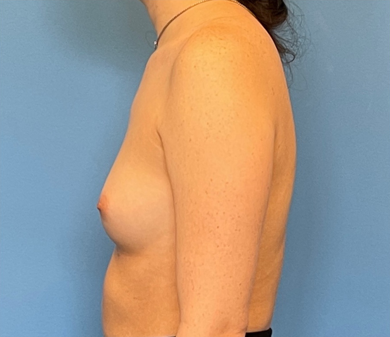Breast-Augmentation-Case--224 | Before Breast 2