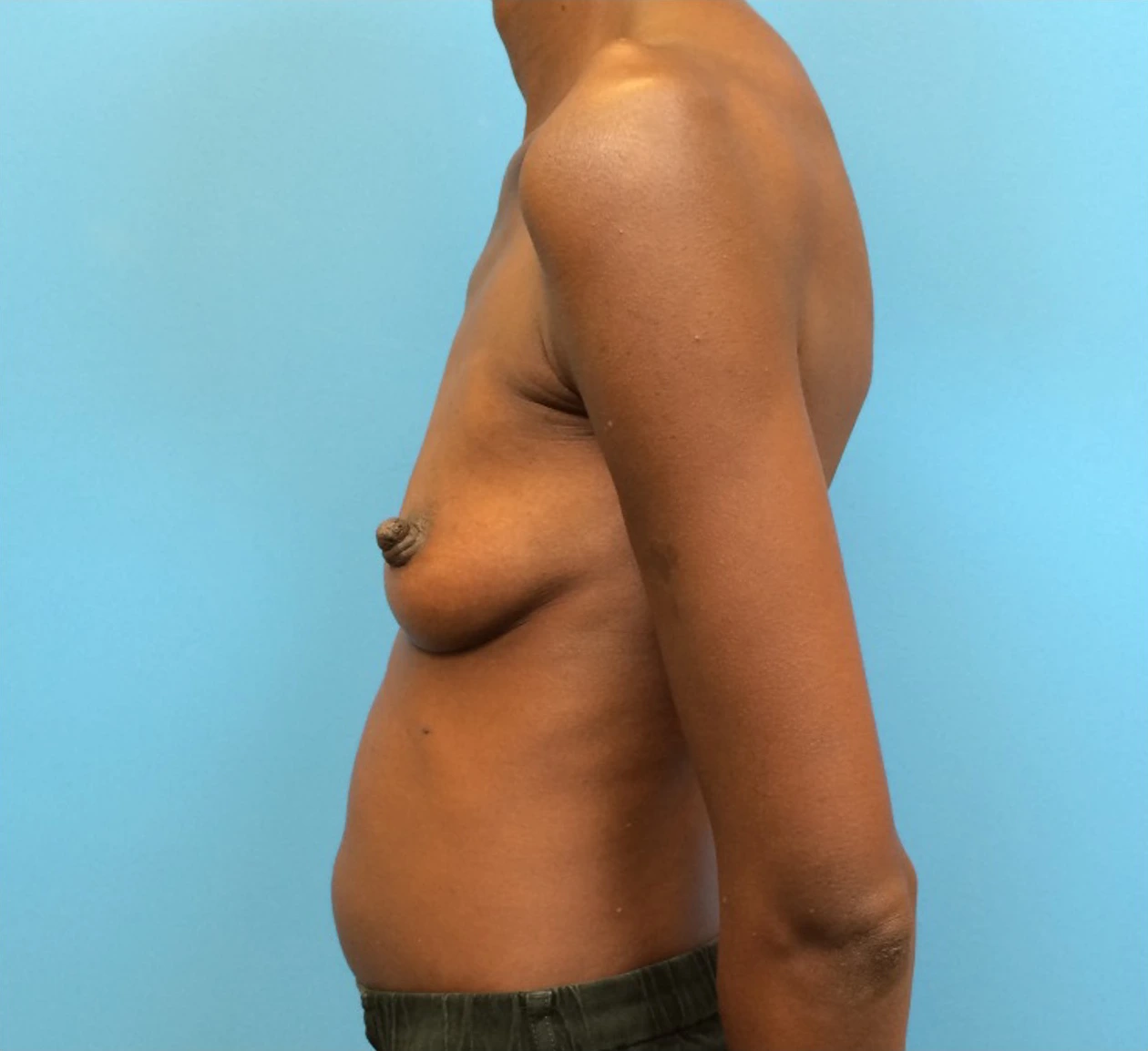 Case--97 | Before Breast 2