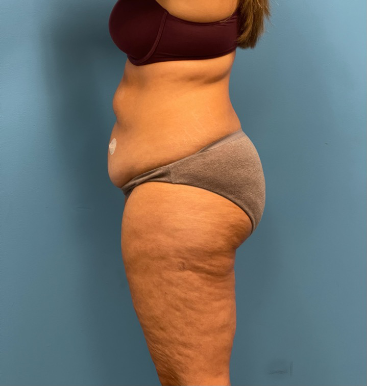 Lipoabdominoplasty-Case--25555 | Before Liposuction 2