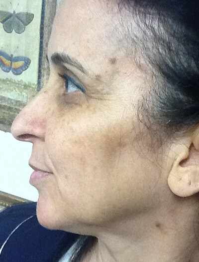 Chemical-Peel-Case--36 | Before Non-Surgical 2