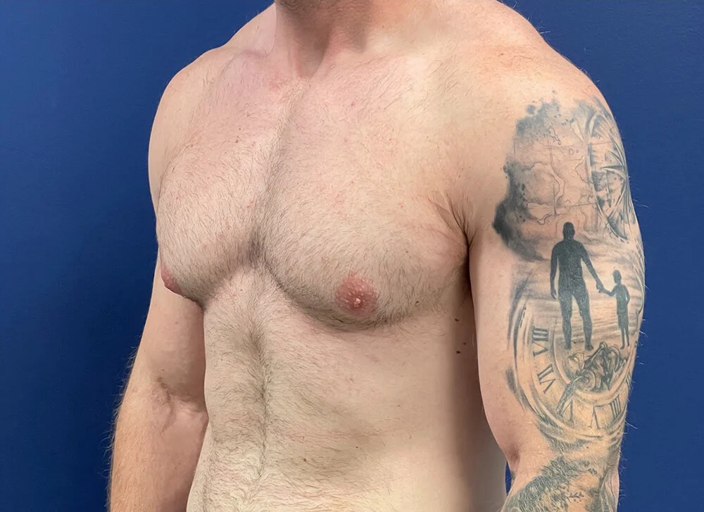 Gynecomastia-Case--28230 | Before Breast 2
