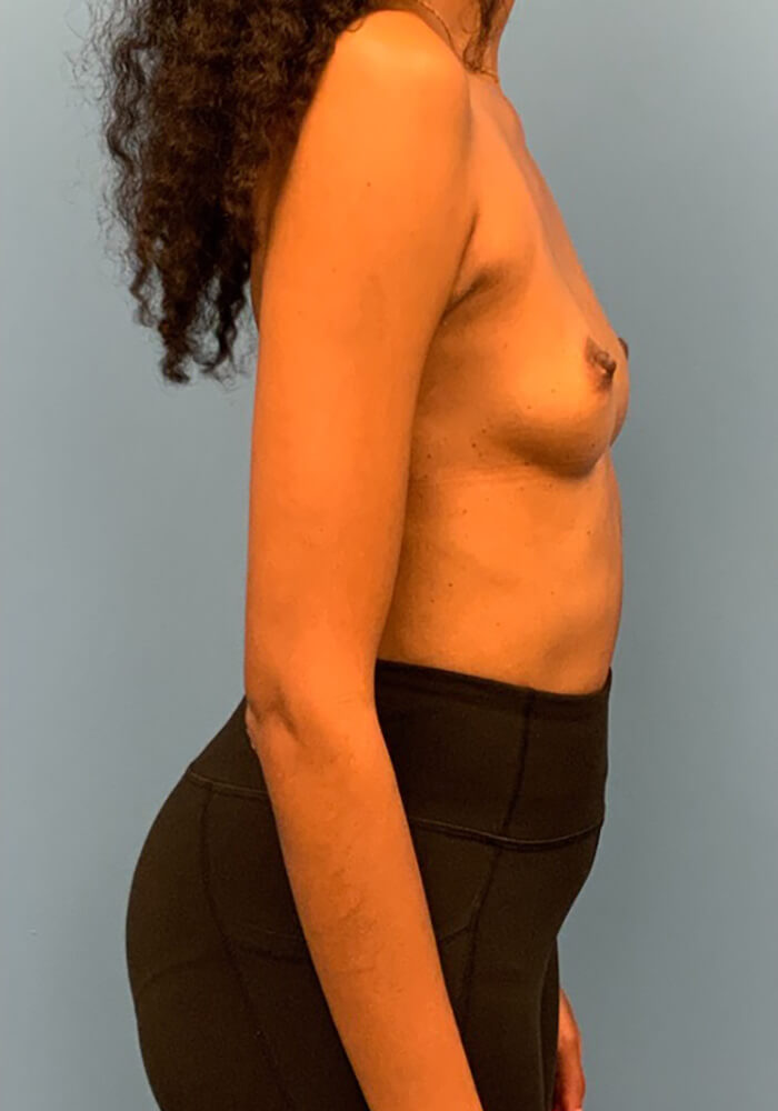 Breast-Augmentation-Case--26022 | Before Breast 2