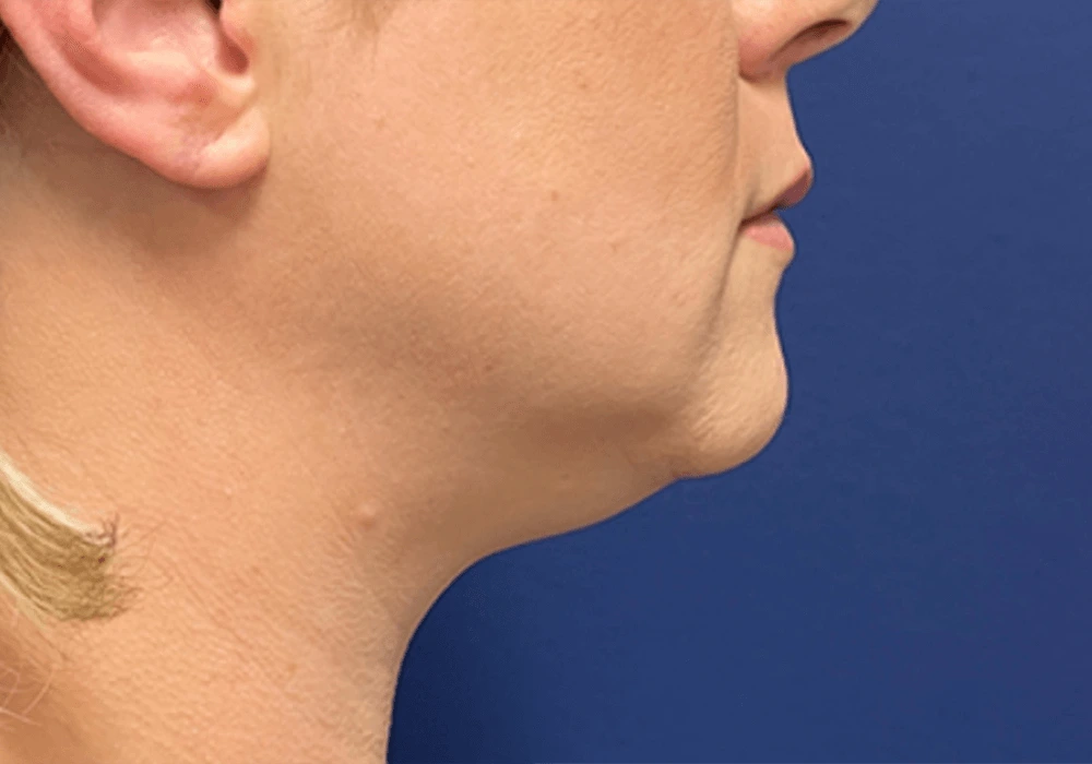 Submental-Liposuction-Case--20811 | Before Submental Liposuction 2