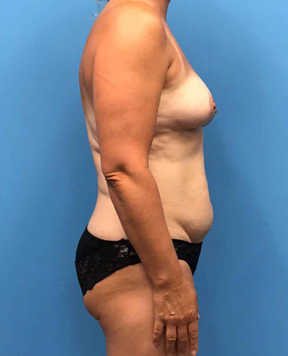 DIEP-Flap-Case--139 | Before Breast 2