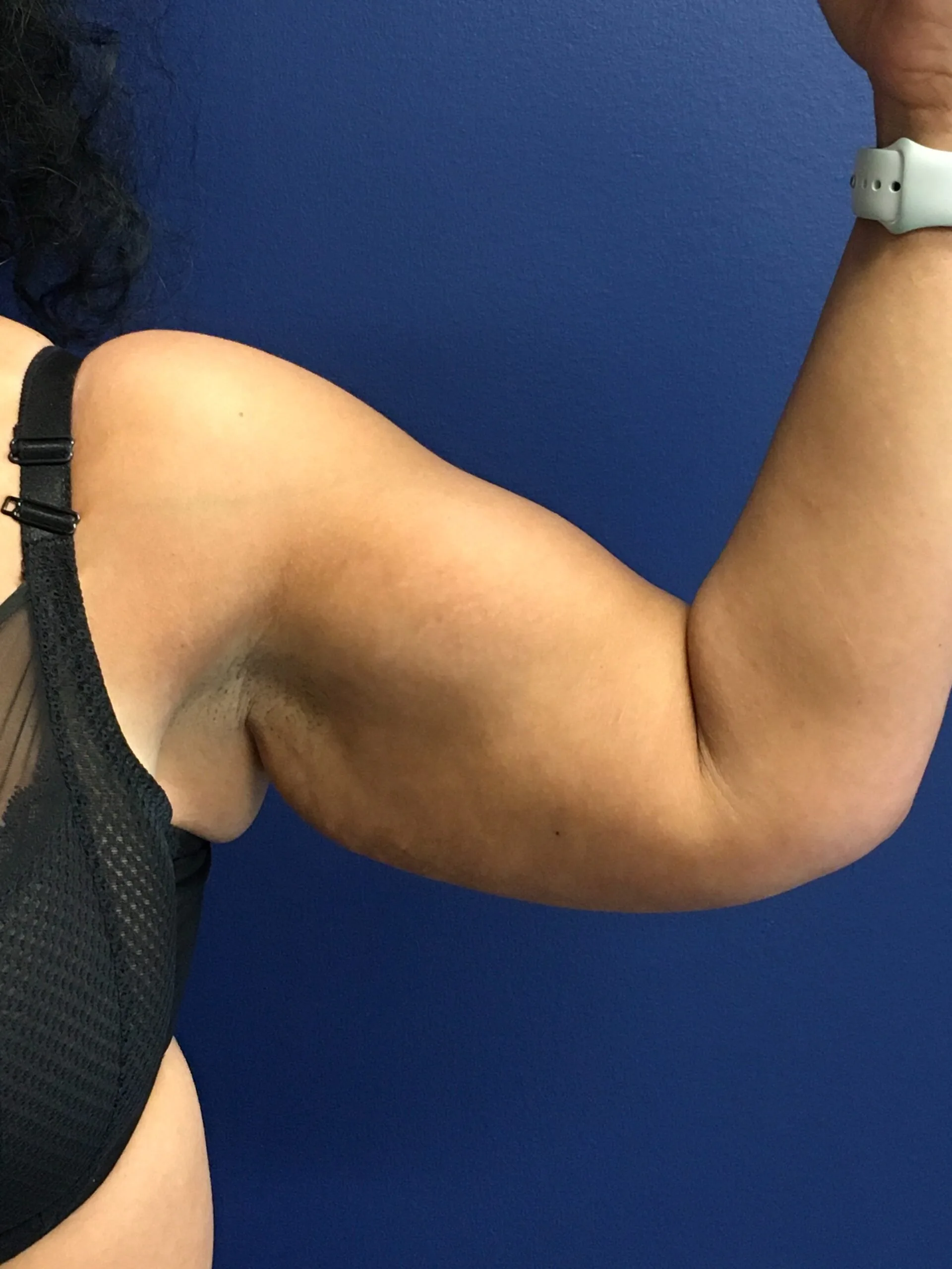 Brachioplasty-Case--1162 | Before Arm Lift 3