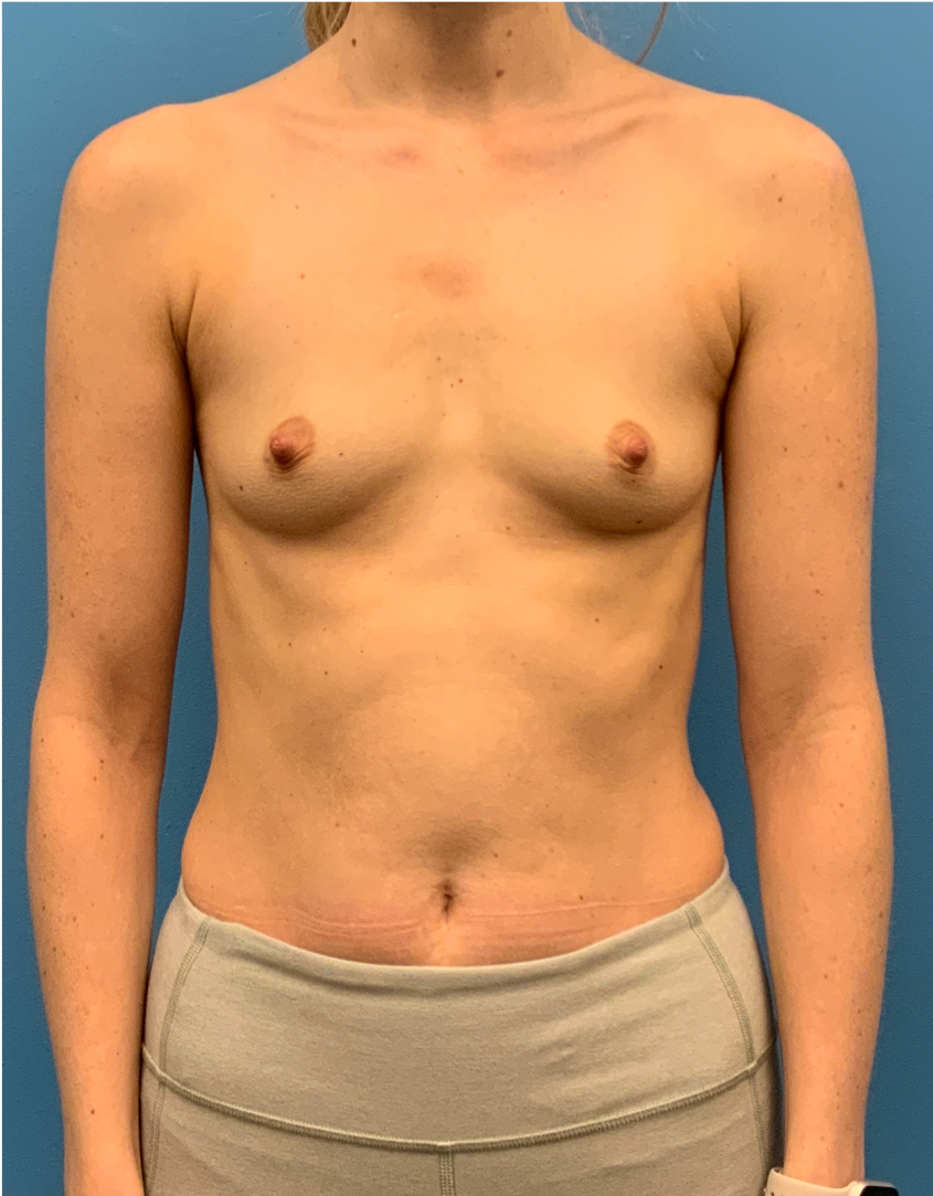 Breast-Augmentation-Case--5309 | Before Breast 1