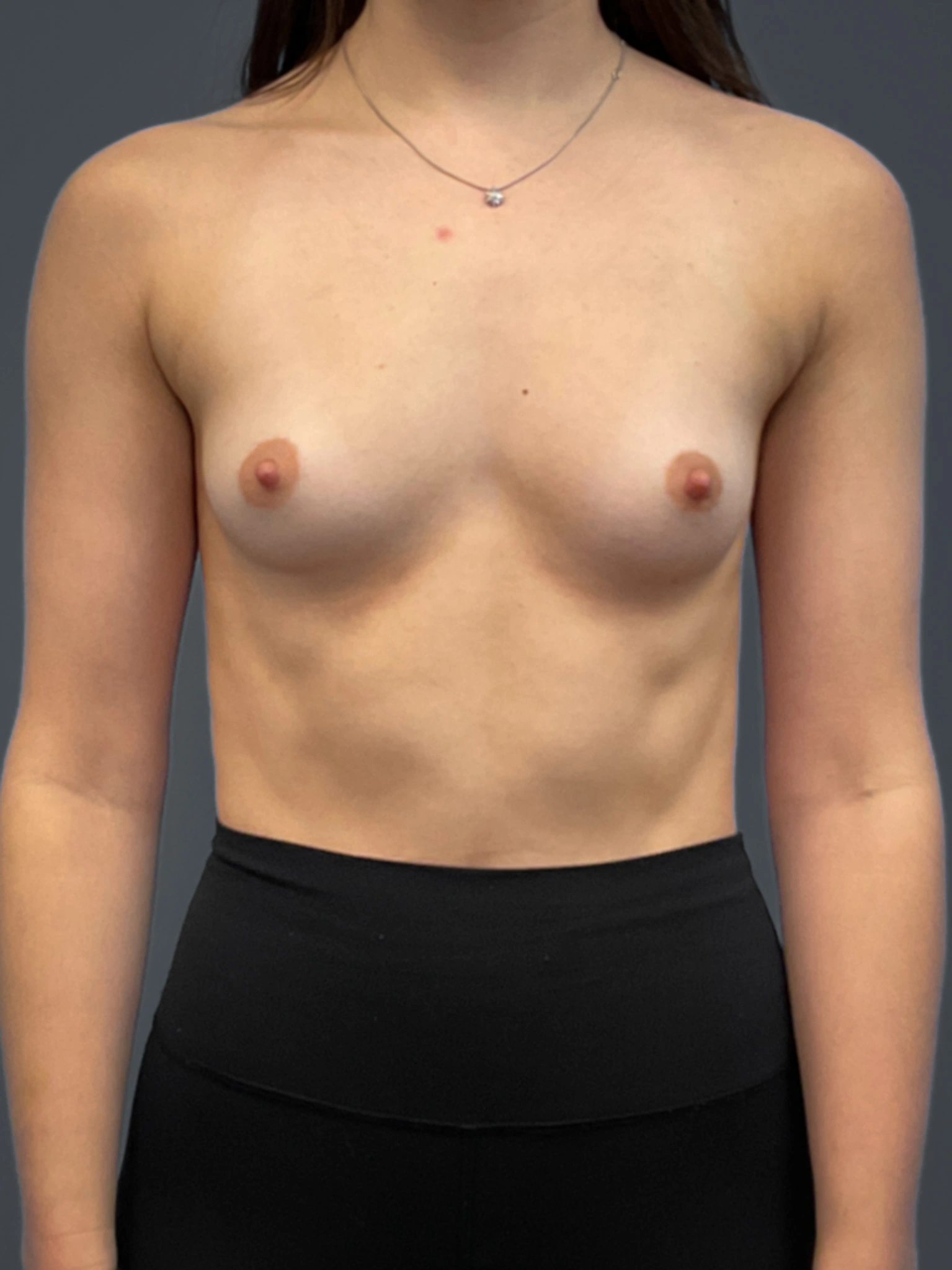 Breast-Augmentation-Case--6687 | Before Breast 1