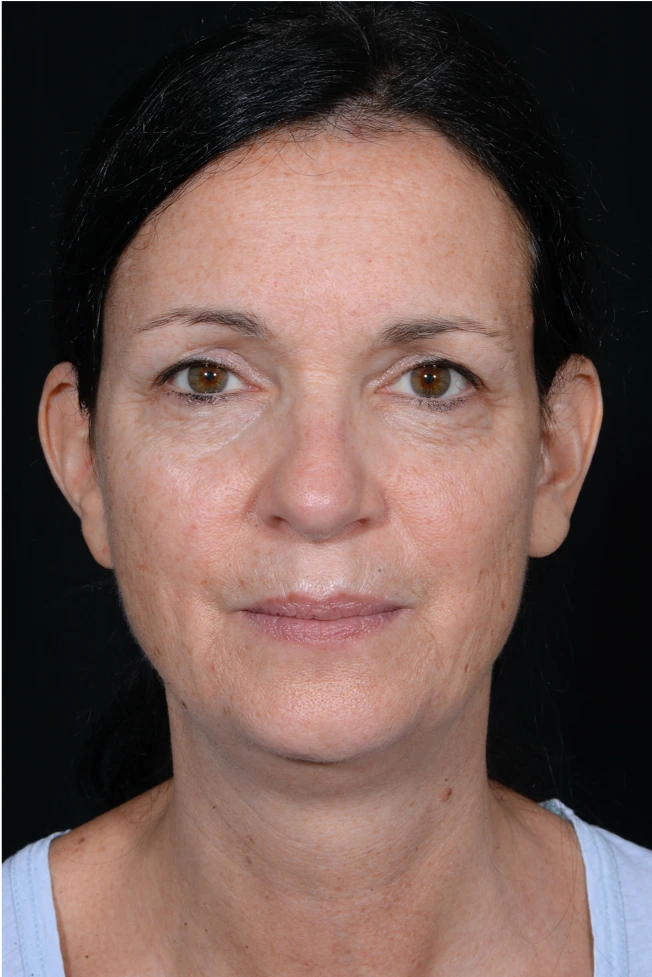 Face-and-Neck-Lift-Case--9403 | Before Neck Lift 1