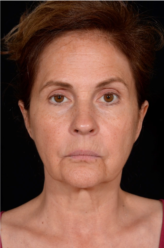 Facelift-Case--4160 | Before Facelift 1