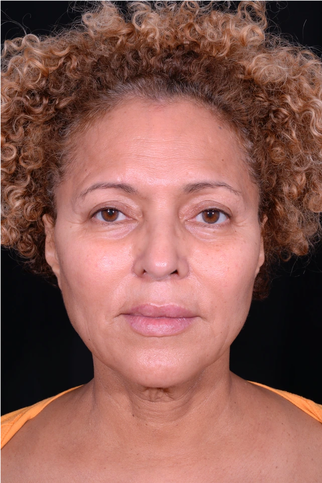 Face-and-Neck-Lift-Case--3772 | Before Neck Lift 1