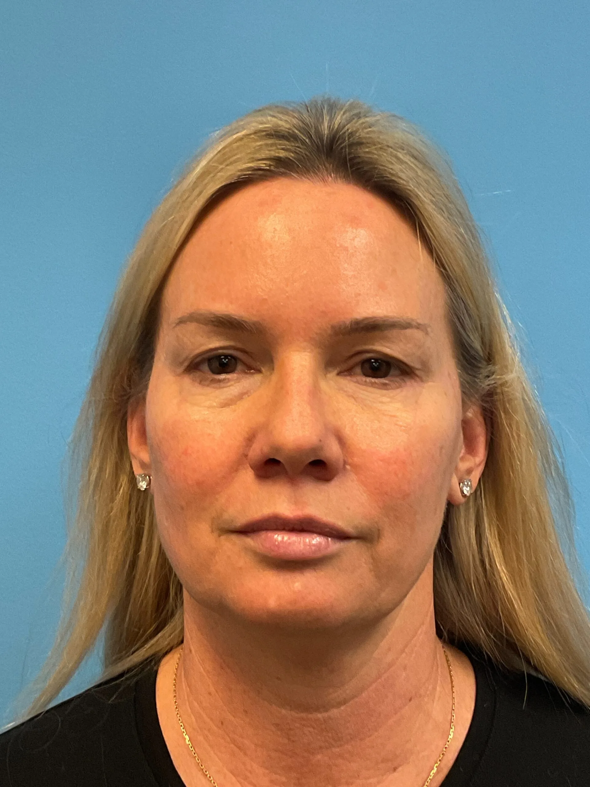 Quad-Blepharoplasty-Case--4265 | Before Dr. Arjun Kanuri 1