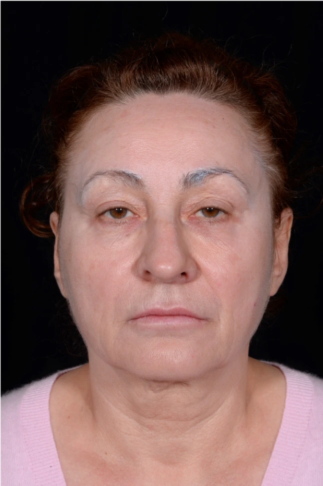 Face-and-Neck-Lift-Case--8423 | Before Neck Lift 1