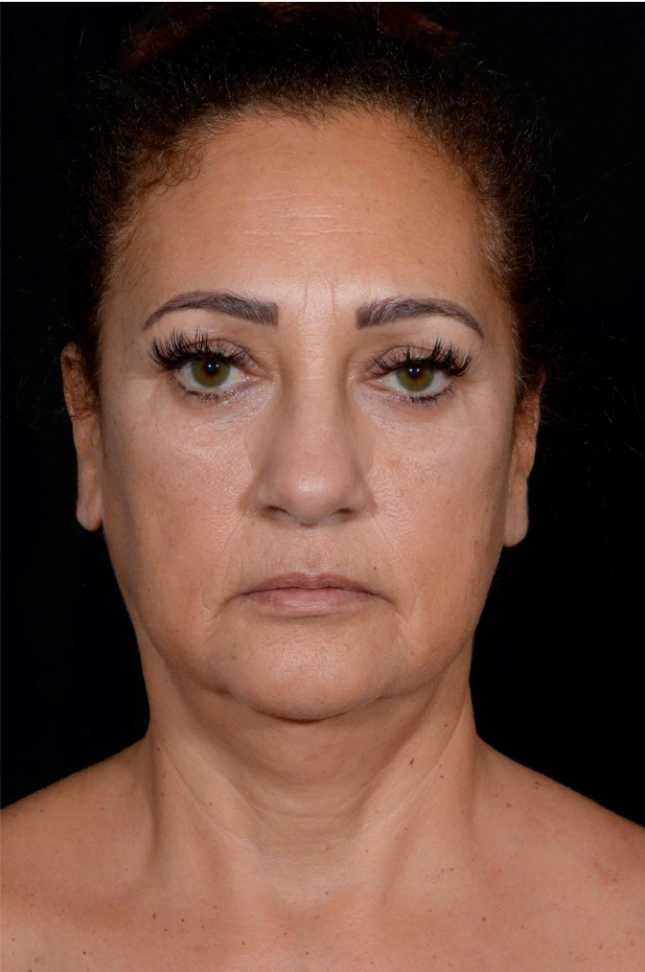 Rhinoplasty-Case--8713 | Before Dr. Arjun Kanuri 1