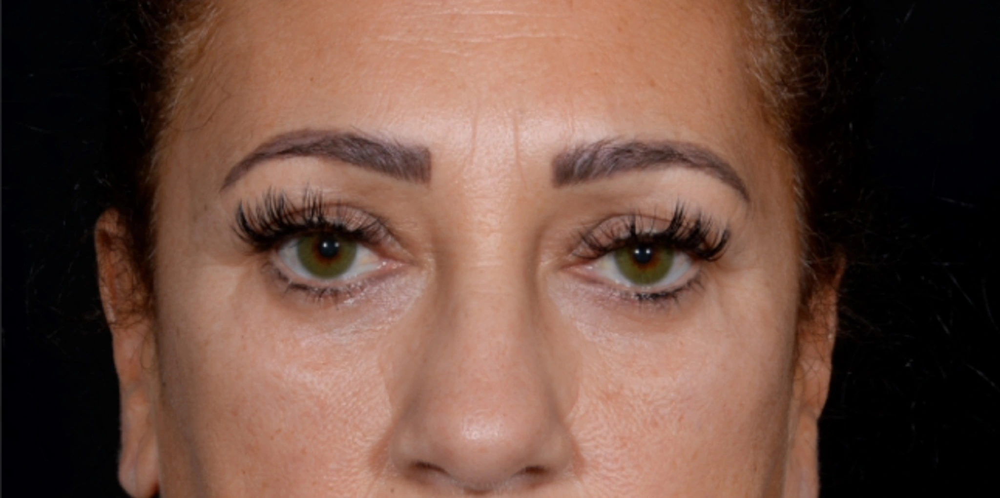 Brow-Lift-Case--6540 | Before Brow Lift 1