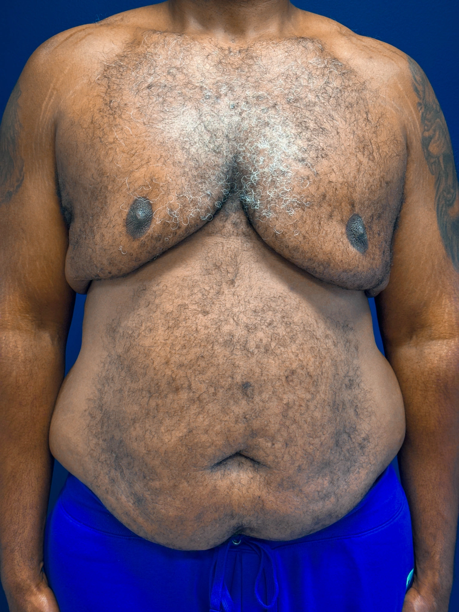 Gynecomastia-Case--4473 | Before Breast 1