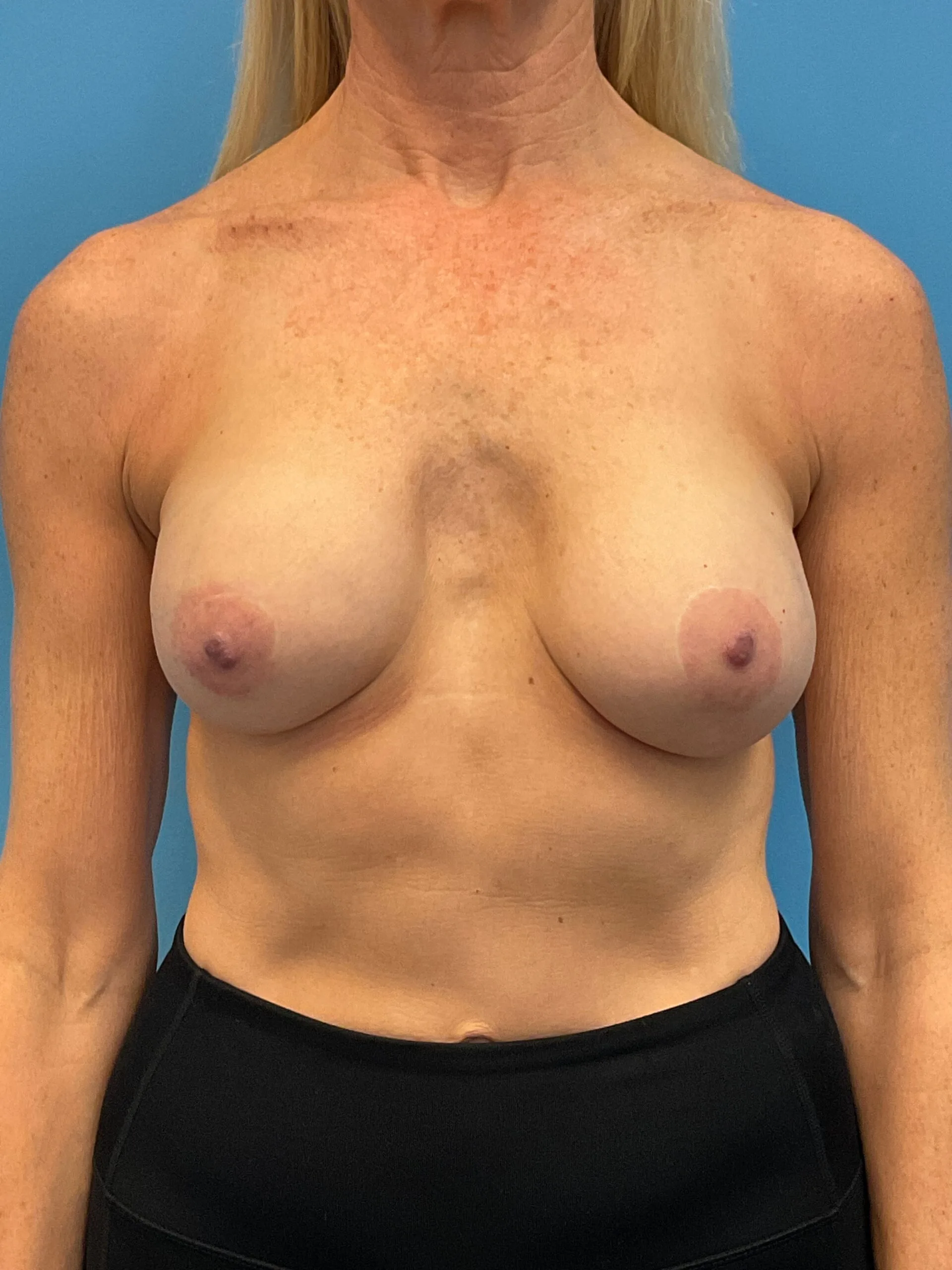 Augmentation-Mastopexy-Case--1505 | Before Breast 1