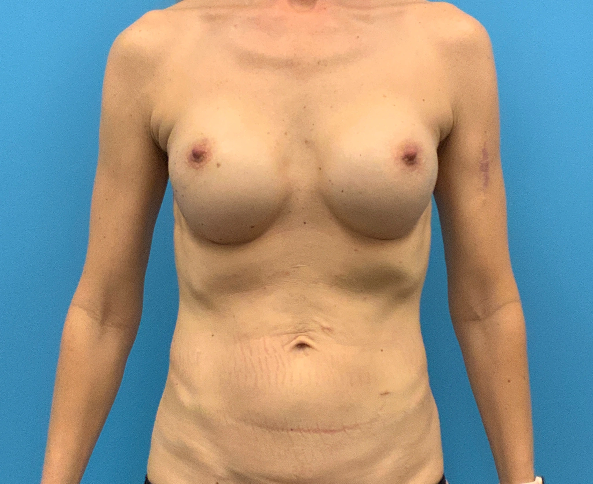 Revision-Breast-Augmentation-Case--4502 | Before Breast 1
