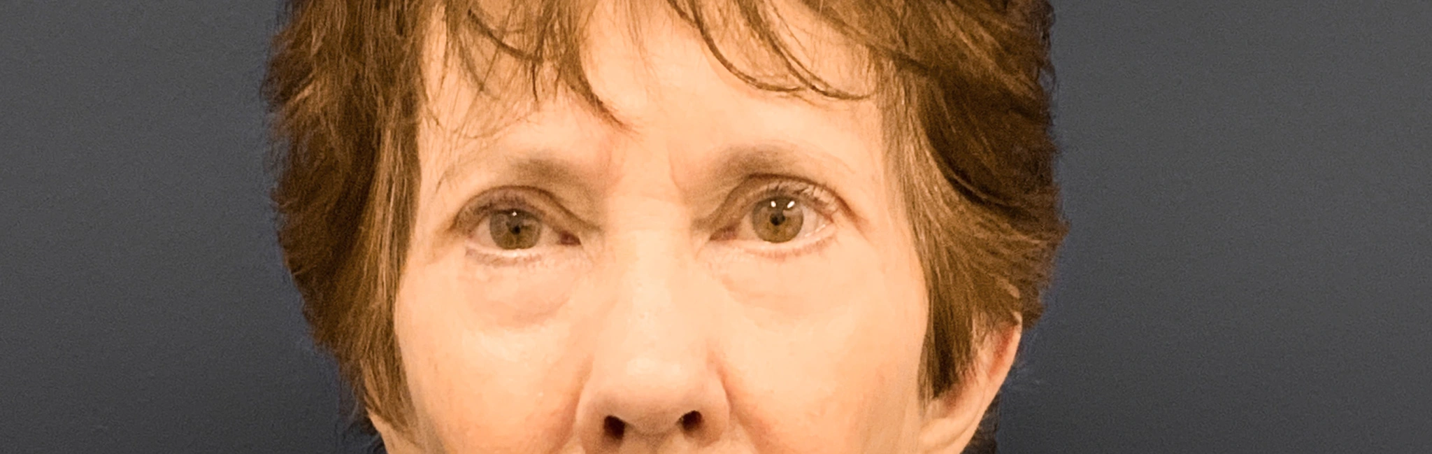 Blepharoplasty-Case--3418 | Before Eyelid Surgery 1