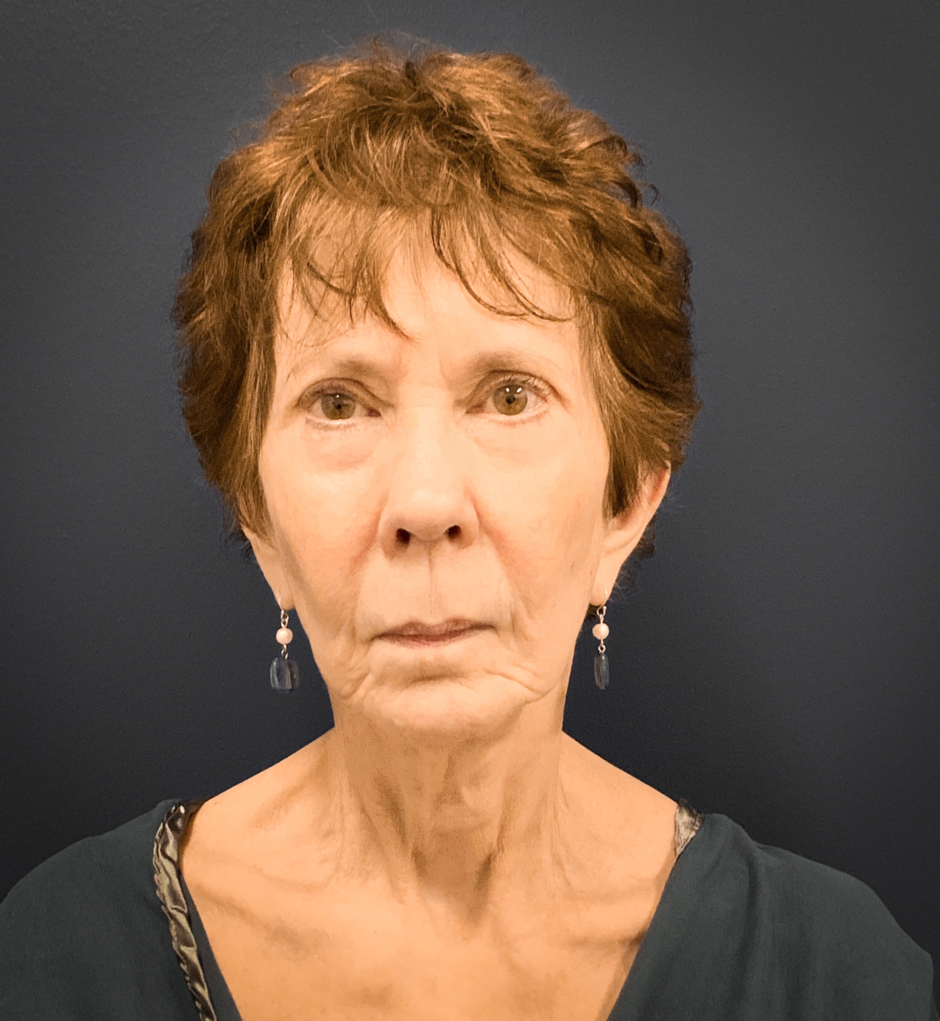 Facelift-and-Facial-Fat-Grafting-Case--5079 | Before Facial Fat Grafting 1