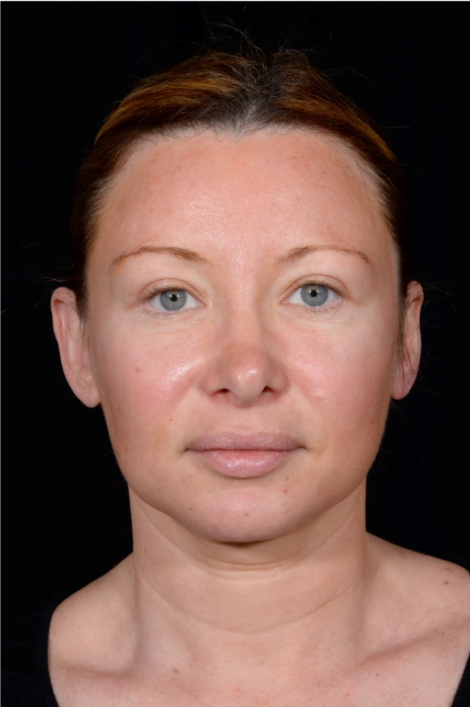 Facelift-and-Facial-Fat-Grafting-Case--1679 | Before Facelift 1