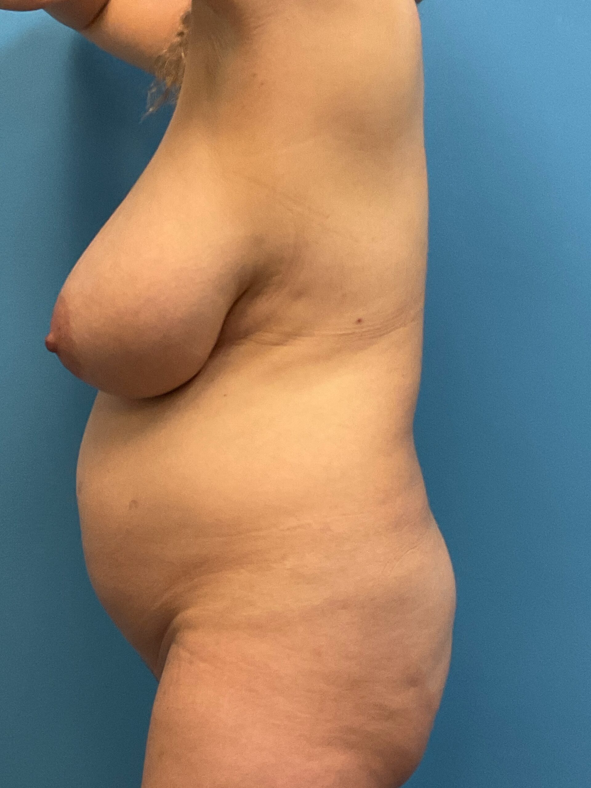 Breast-Reduction-Case--2878 | Before Breast 2