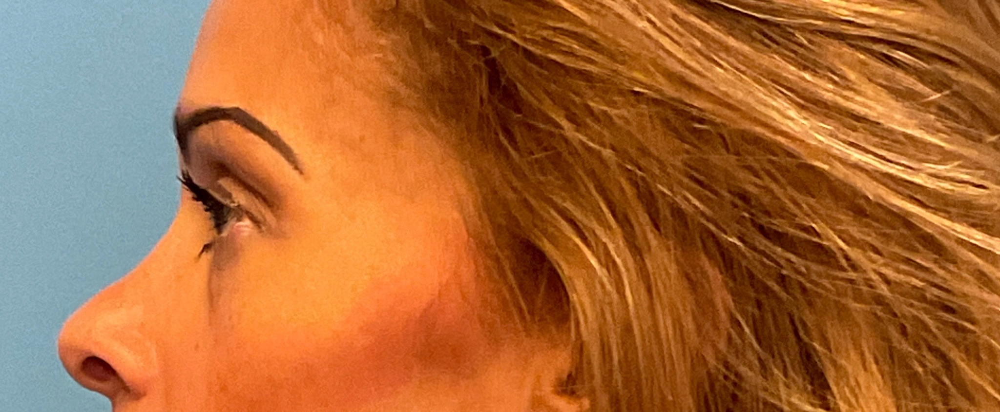 Quad-Blepharoplasty-Case--1261 | Before Eyelid Surgery 3