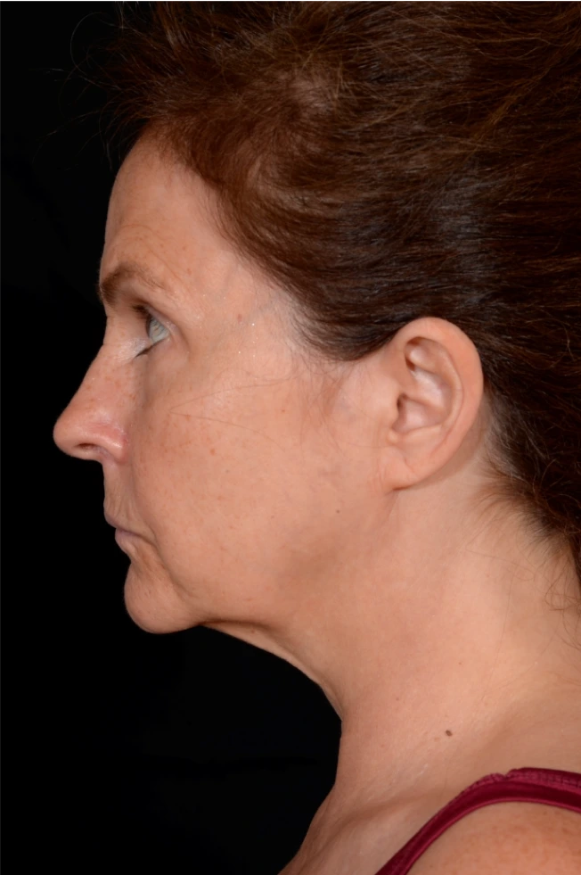 Necklift-Case--4836 | Before Neck Lift 2