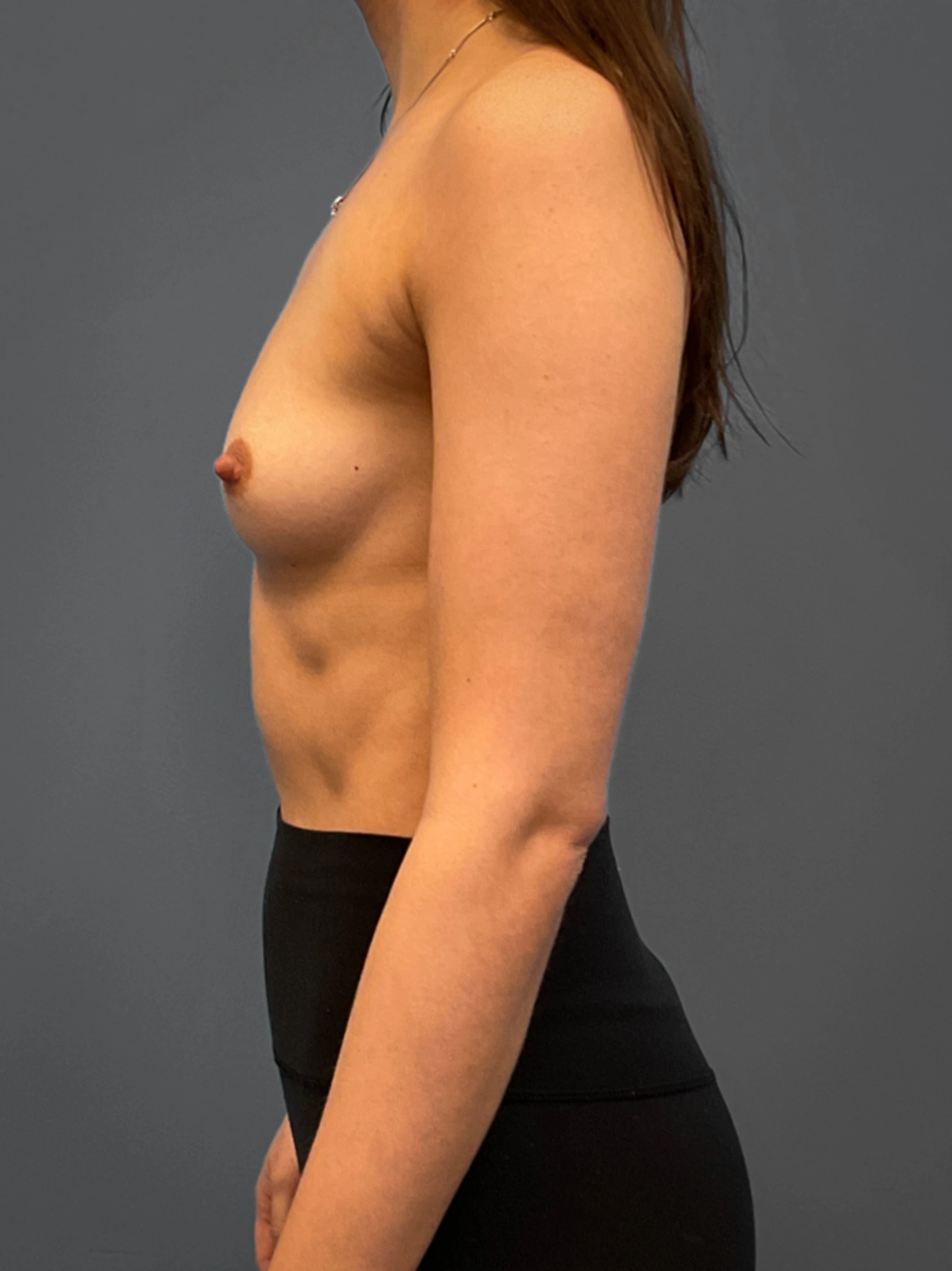 Breast-Augmentation-Case--6687 | Before Breast 2