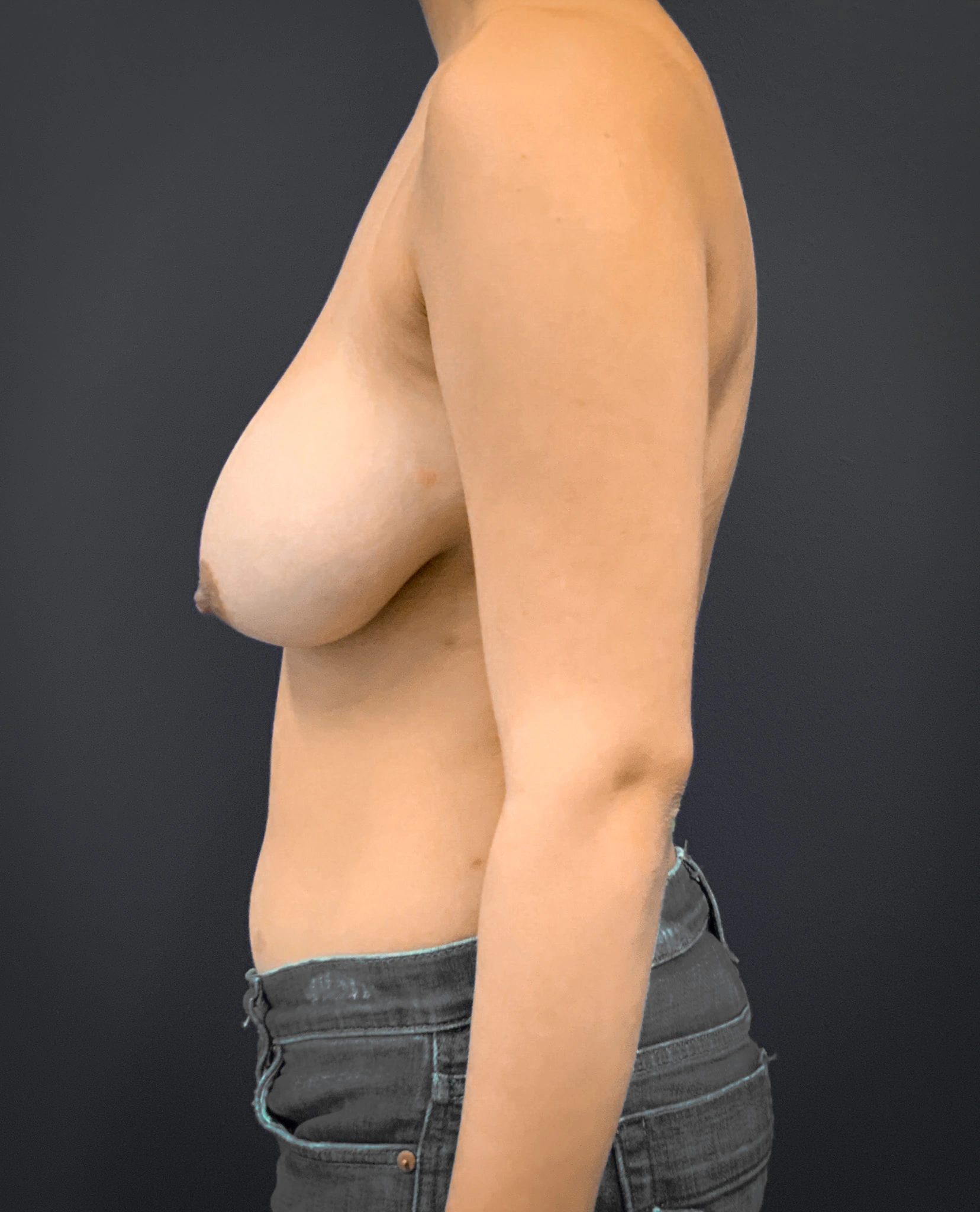 Breast-Reduction-Case--2399 | Before Breast 2