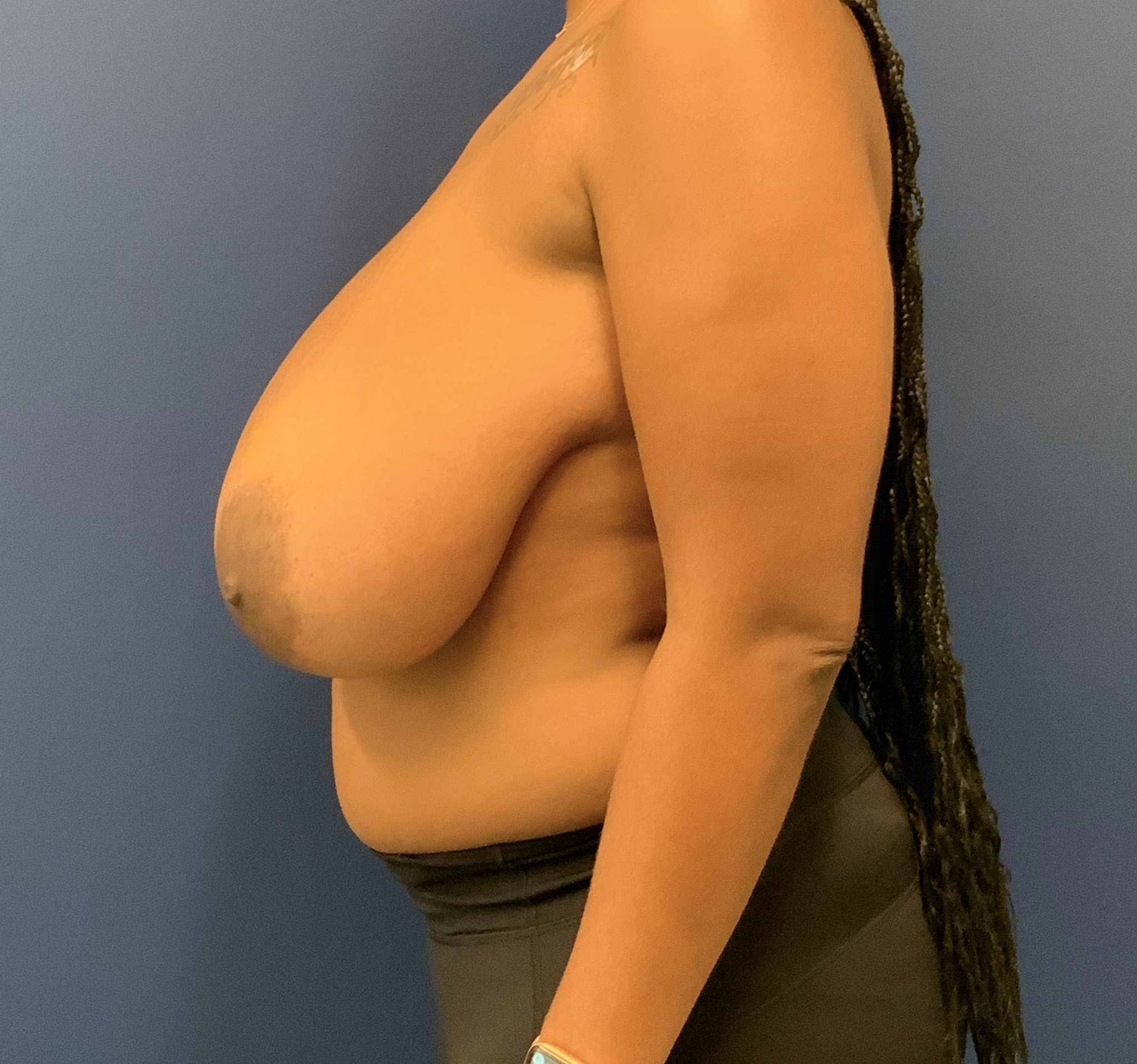 Breast-Reduction-Case--9235 | Before Breast 2