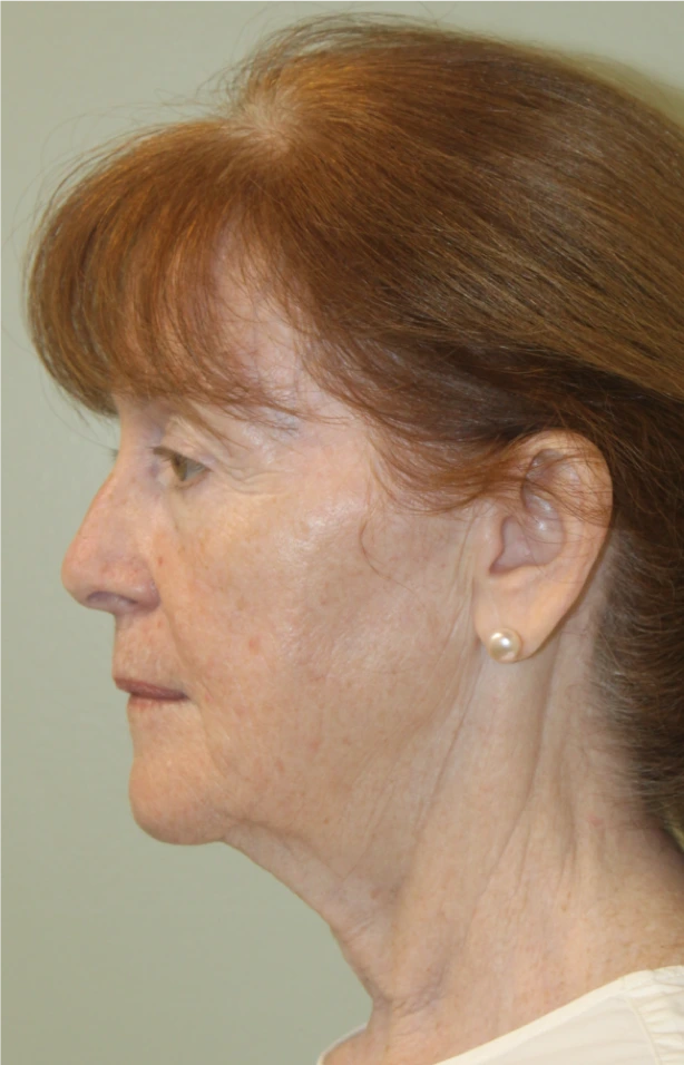 Face-and-Neck-Lift-Case--9302 | Before Neck Lift 2