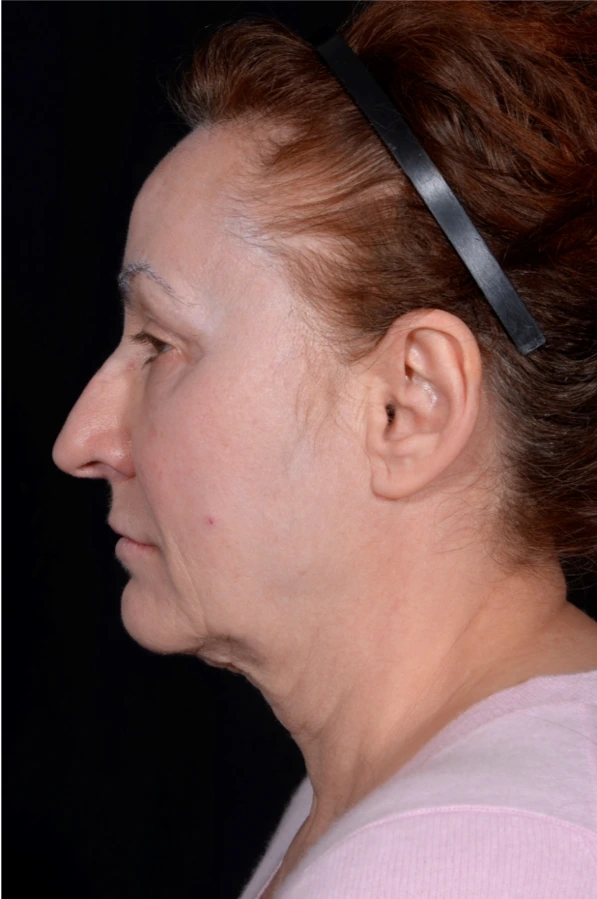 Face-and-Neck-Lift-Case--8423 | Before Neck Lift 2