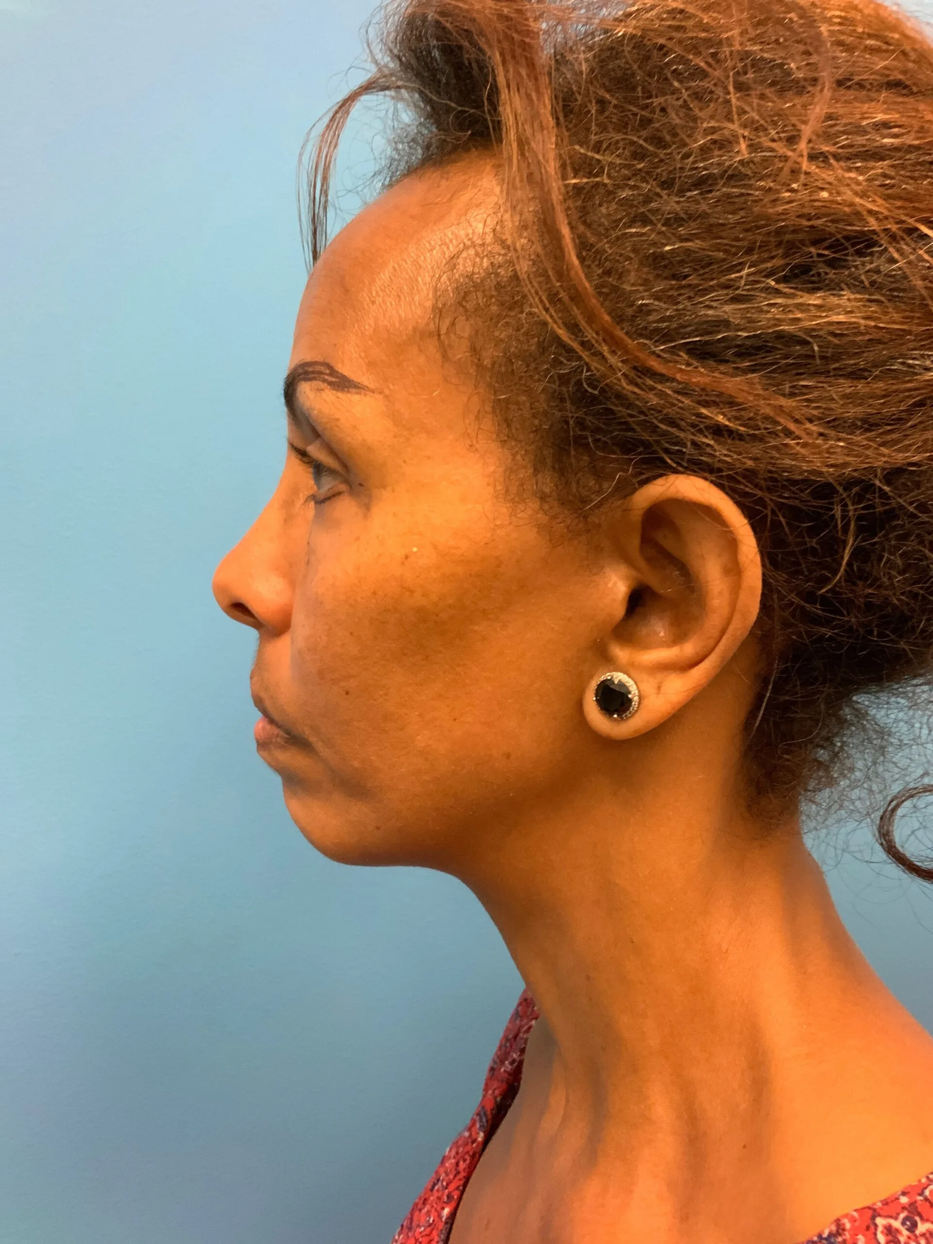 Facelift-Case--1863 | Before Facelift 3