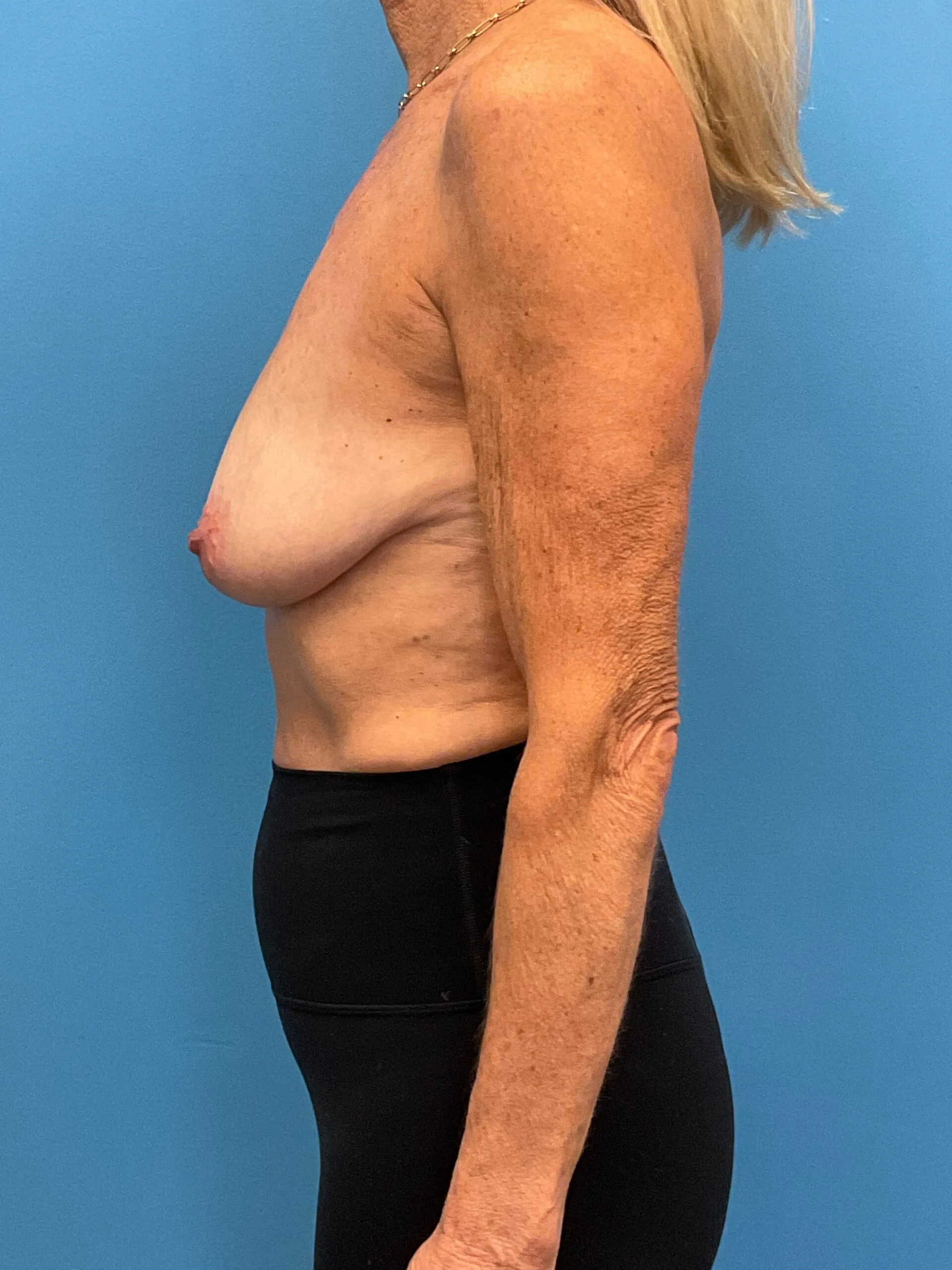 Mastopexy-Case--9216 | Before Breast 2