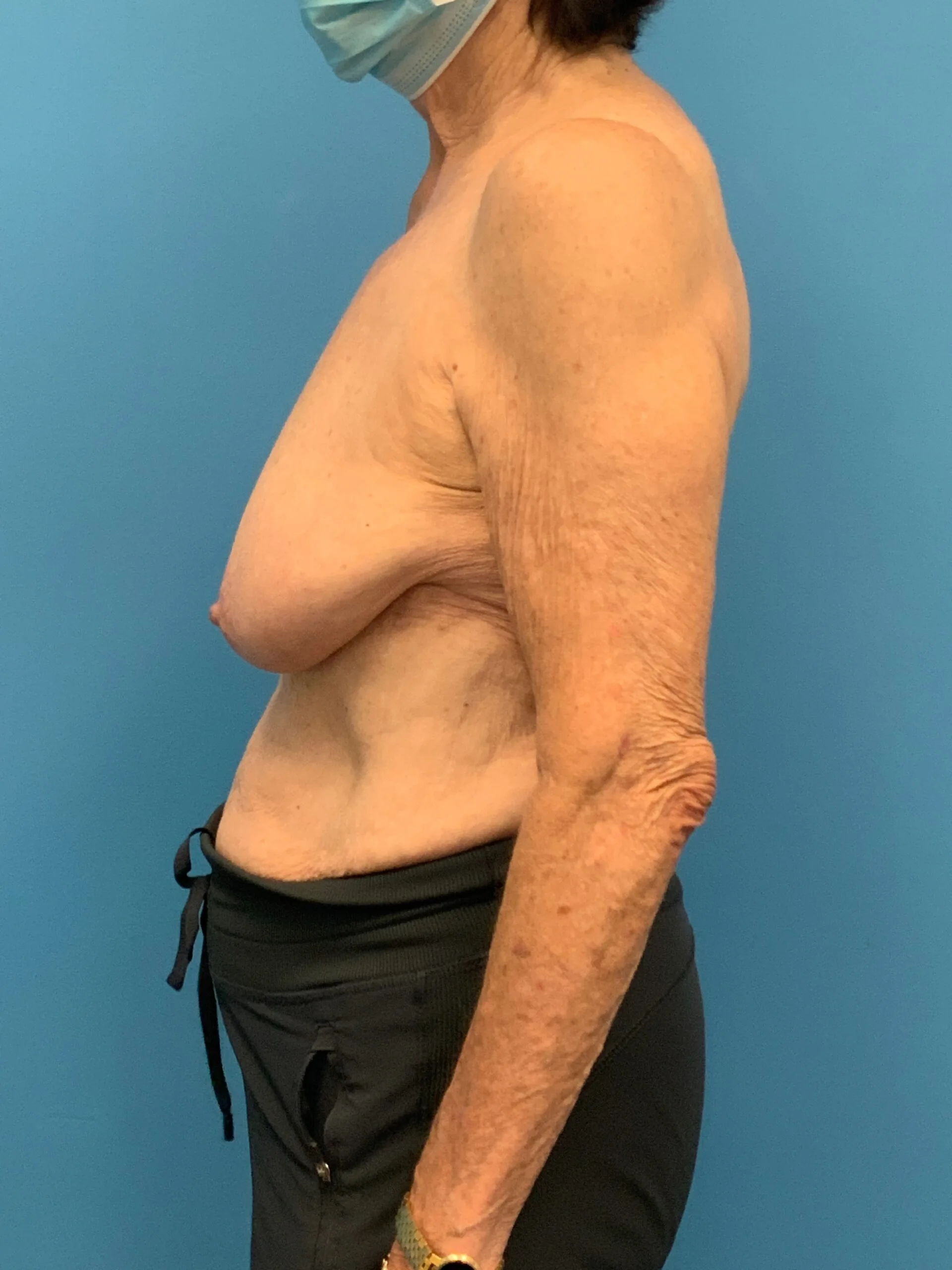 Augmentation-Mastopexy-Case--4504 | Before Breast 2